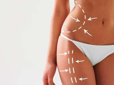 ¿Cuál es el mejor tipo de abdominoplastia? (Spanish)